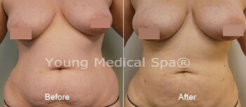 Breast Augmentation Before and After 3 | Young Medical Spa | Central Valley PA, Lansdale PA, Forty Port PA