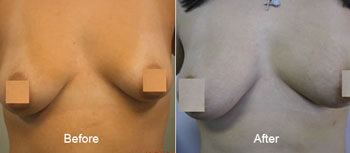 Breast Augmentation Before and After 2 | Young Medical Spa | Central Valley PA, Lansdale PA, Forty Port PA