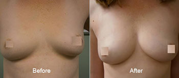 Breast Augmentation Before and After 1 | Young Medical Spa | Central Valley PA, Lansdale PA, Forty Port PA