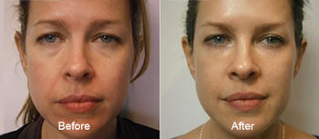 chemical peel before after thomas young md | Young Medical Spa | Central Valley PA, Lansdale PA, Forty Port PA