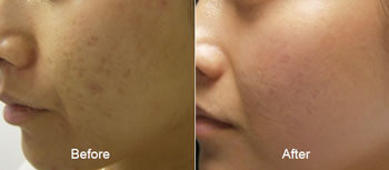 microneedling micropen before after thomas young md | Young Medical Spa | Central Valley PA, Lansdale PA, Forty Port PA