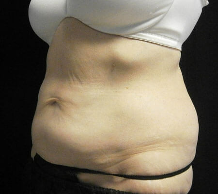 CoolSculpting Flanks (Love Handles) Before & After Photos - Cosmetic -  Ark-La-Tex Dermatology & Medical Spa - Louisiana - A Part of the  Willis-Knighton Physician Network