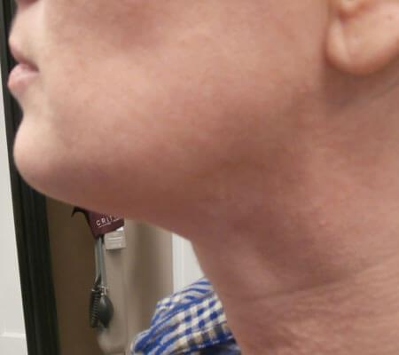 Precision TX After Side View | Young Medical Spa