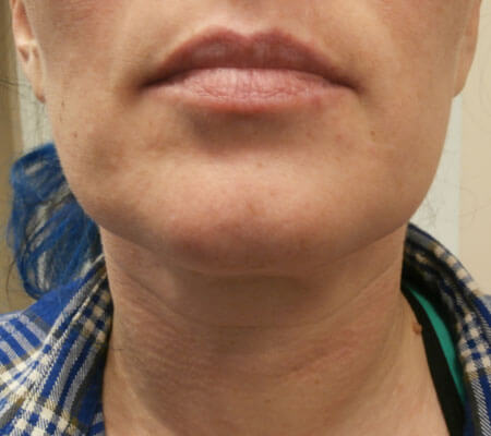 Precision TX After Front View | Young Medical Spa