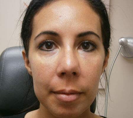 Thread Lift After Front View | Young Medical Spa | Central Valley PA