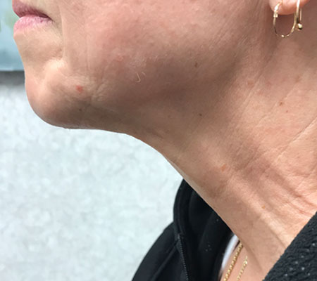 Thread Lift After 2 | Young Medical Spa | Central Valley PA