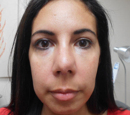 PDO Thread Face lift New Hope, PA, PDO Thread Face lift Bucks County PA,  PDO Face lift near Doylestown PA, PDO Thread facelift near Newtown PA - La  Chele Medical Aesthetics, LLC