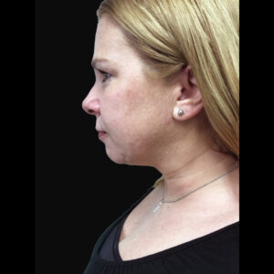 Facetite Left Side After | Young Medical Spa | Central Valley PA, Lansdale PA, Forty Port PA