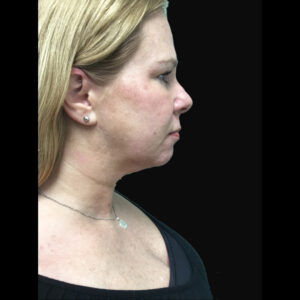 Facetite Right Side After | Young Medical Spa | Central Valley PA, Lansdale PA, Forty Port PA
