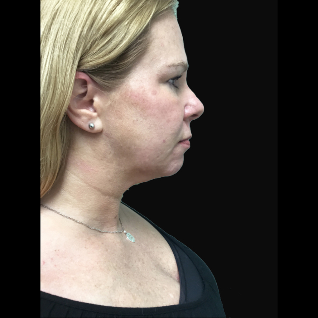 Facetite Right Side After