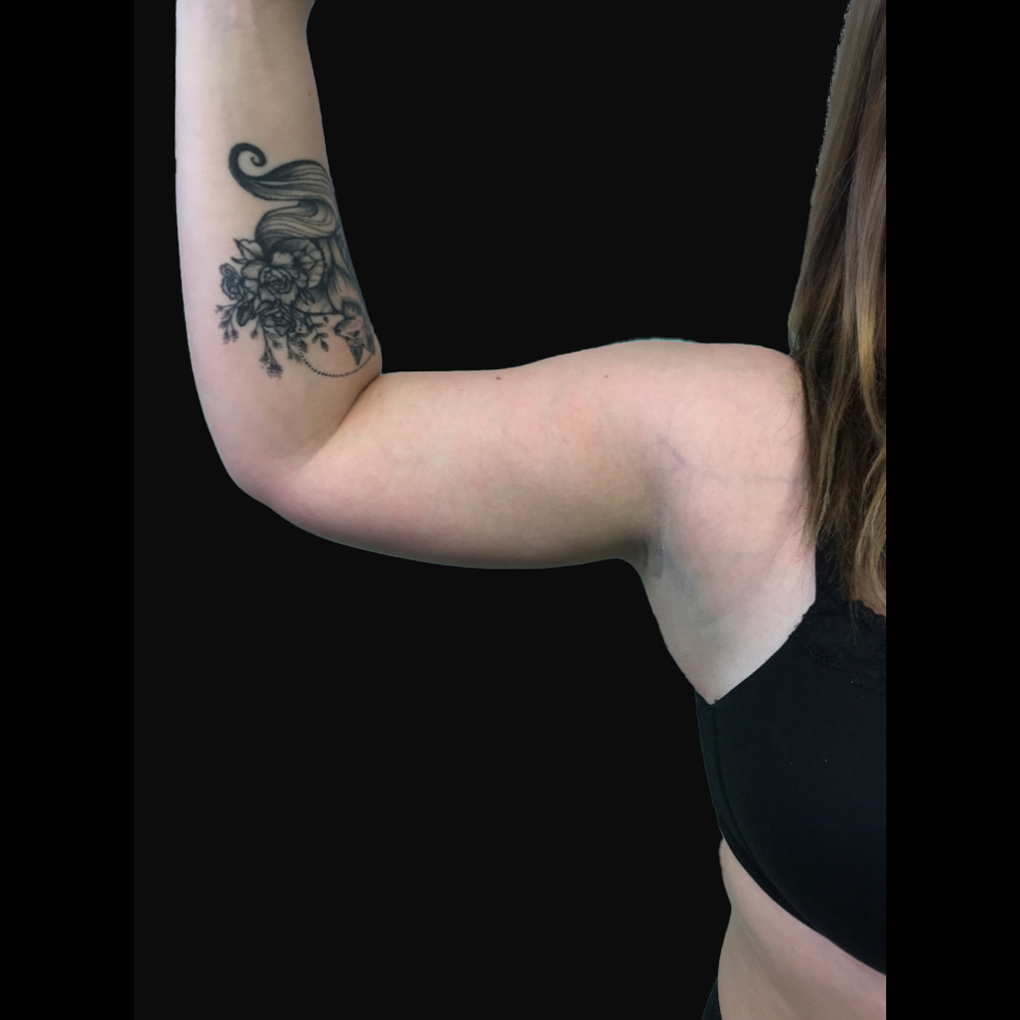 Bodytite Right Arm After