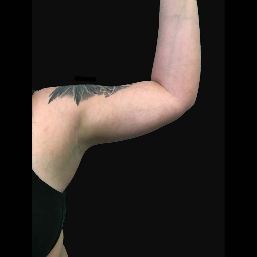 Bodytite Left Arm After