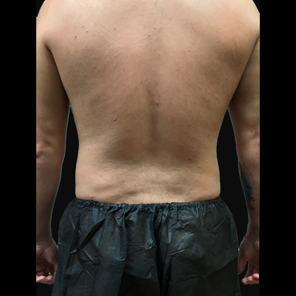 Bodytite Waist After