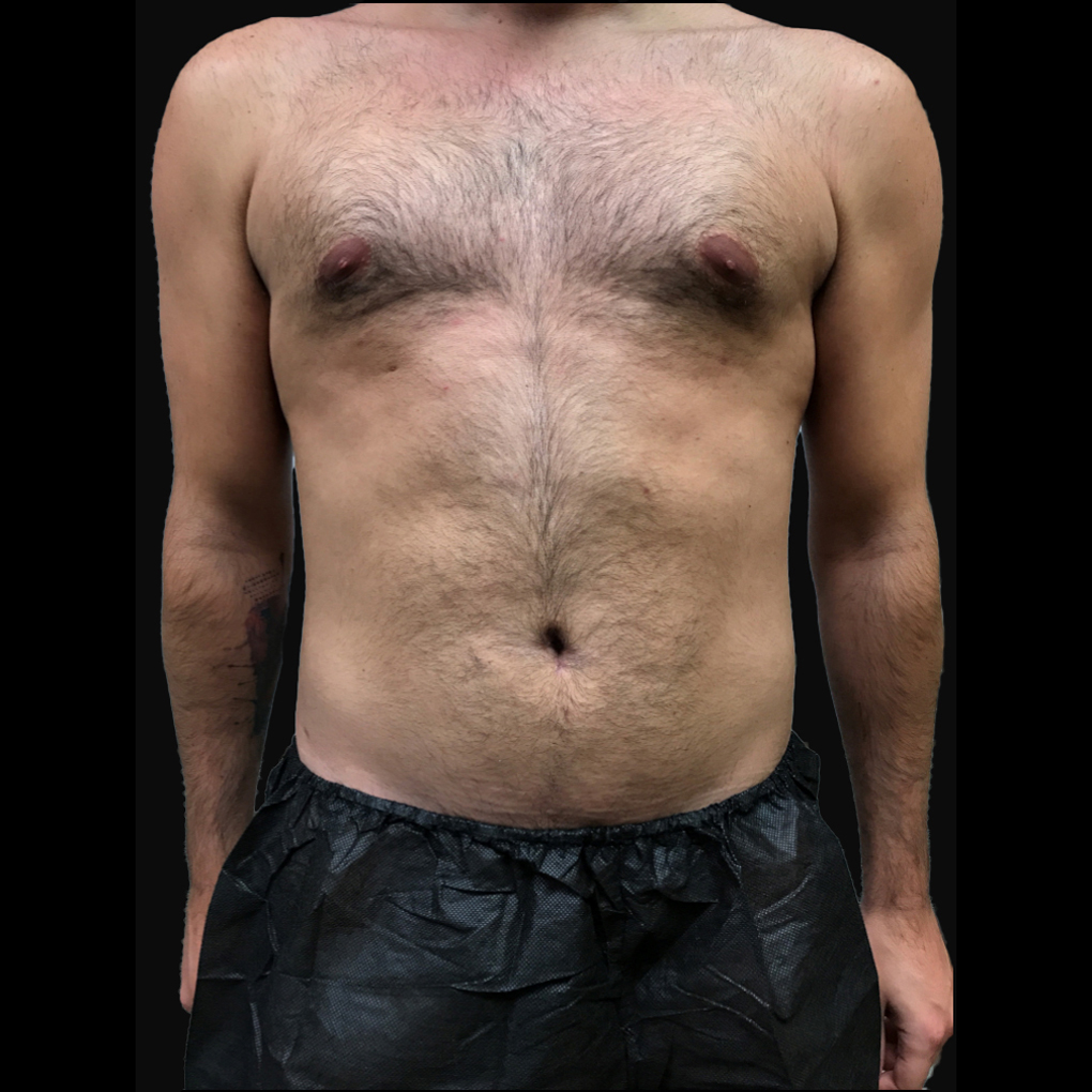 Bodytite Abdomen After