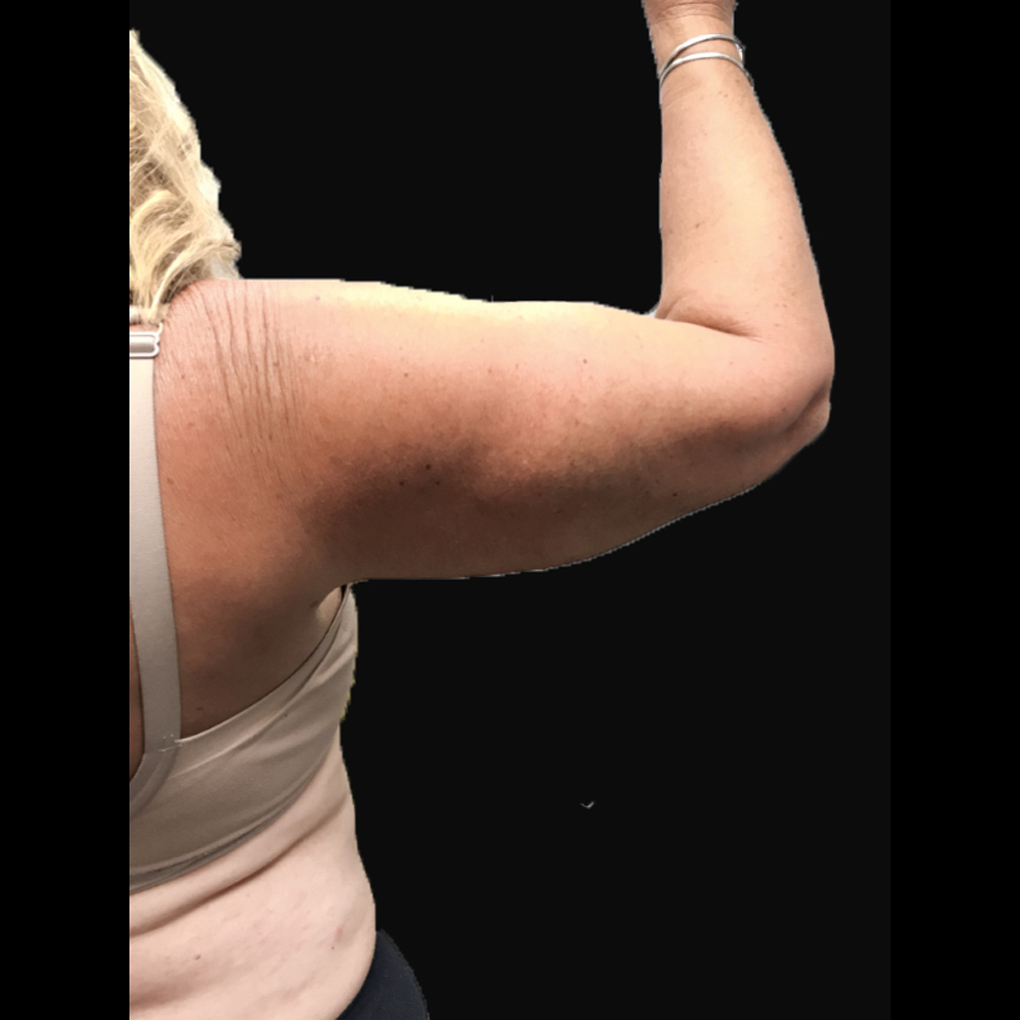 Bodytite Right Arm After