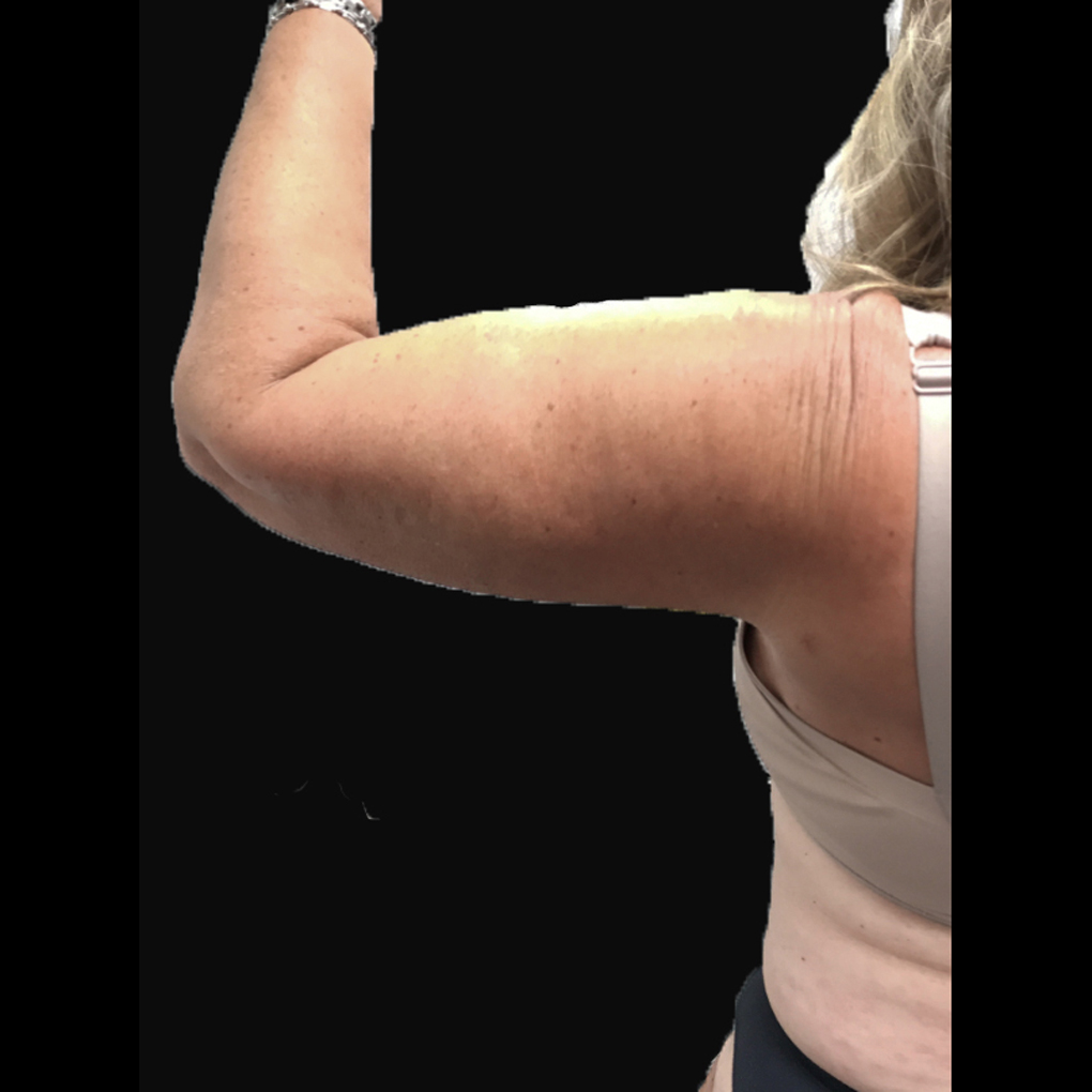 Bodytite Left Arm After