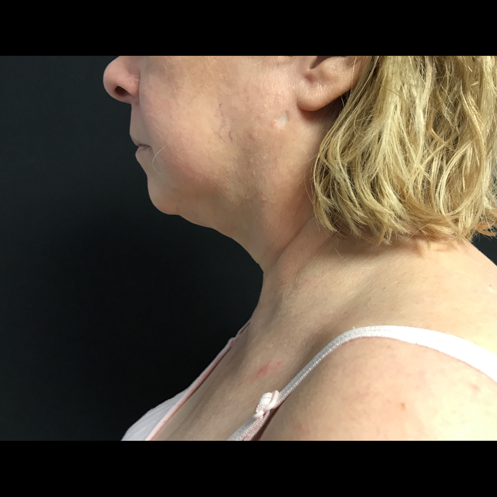 Coolsculpting Chin Side View After