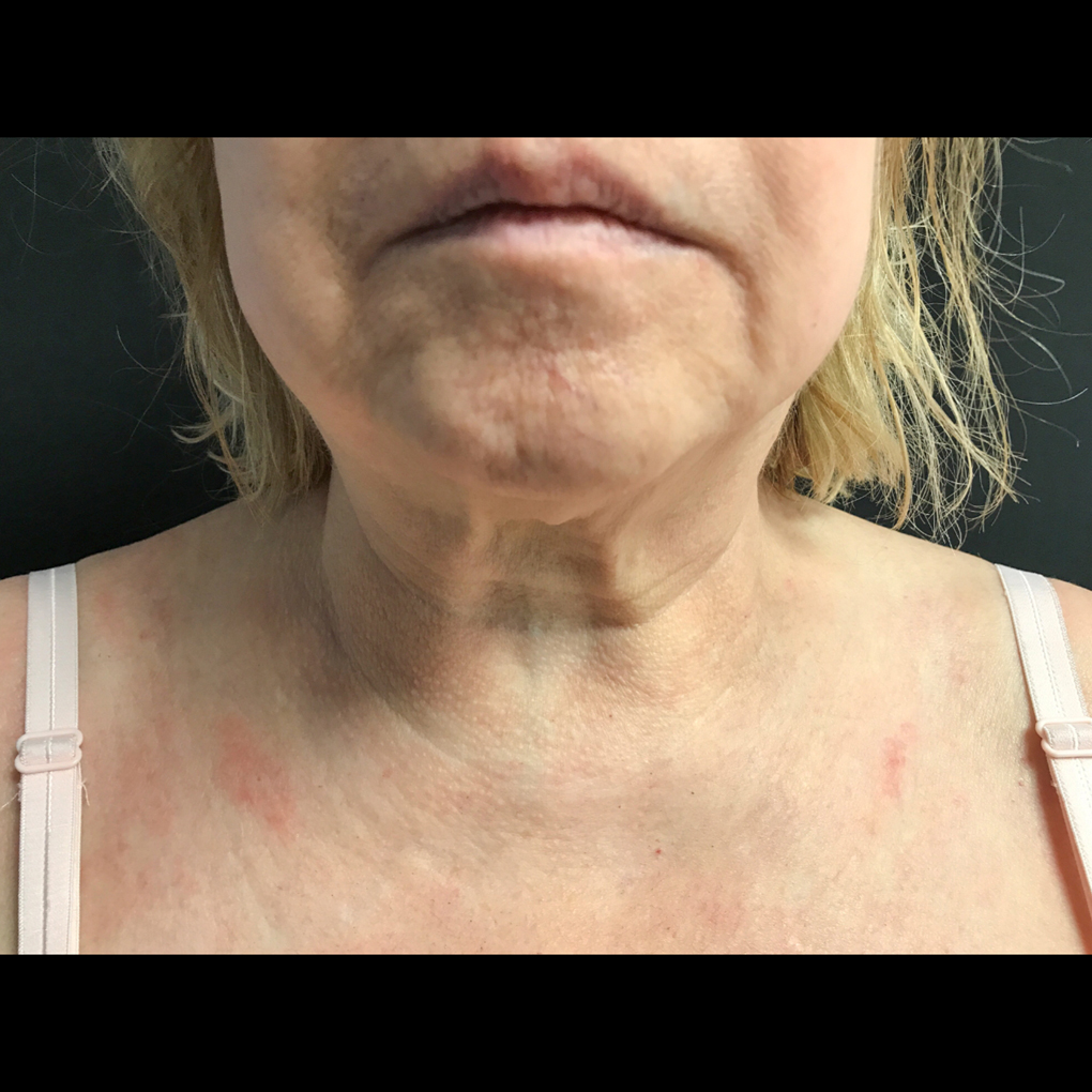 Coolsculpting Chin Front View After