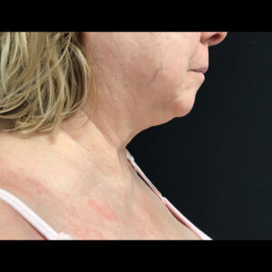 Coolsculpting Chin Side View After | Young Medical Spa | Central Valley PA, Lansdale PA, Forty Port PA