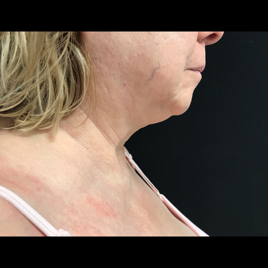 Coolsculpting Chin Side View After