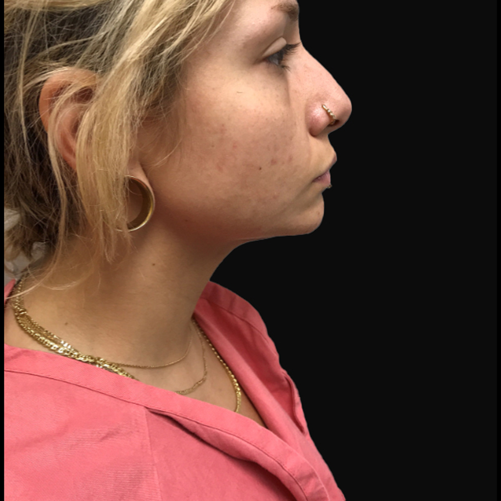 Facetite Chin Right Side After