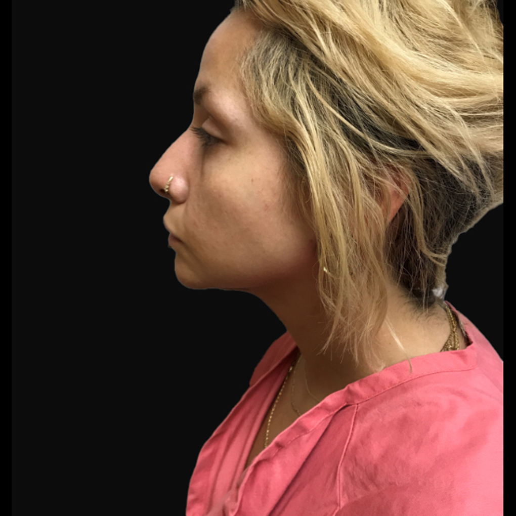 Facetite Chin Left Side After