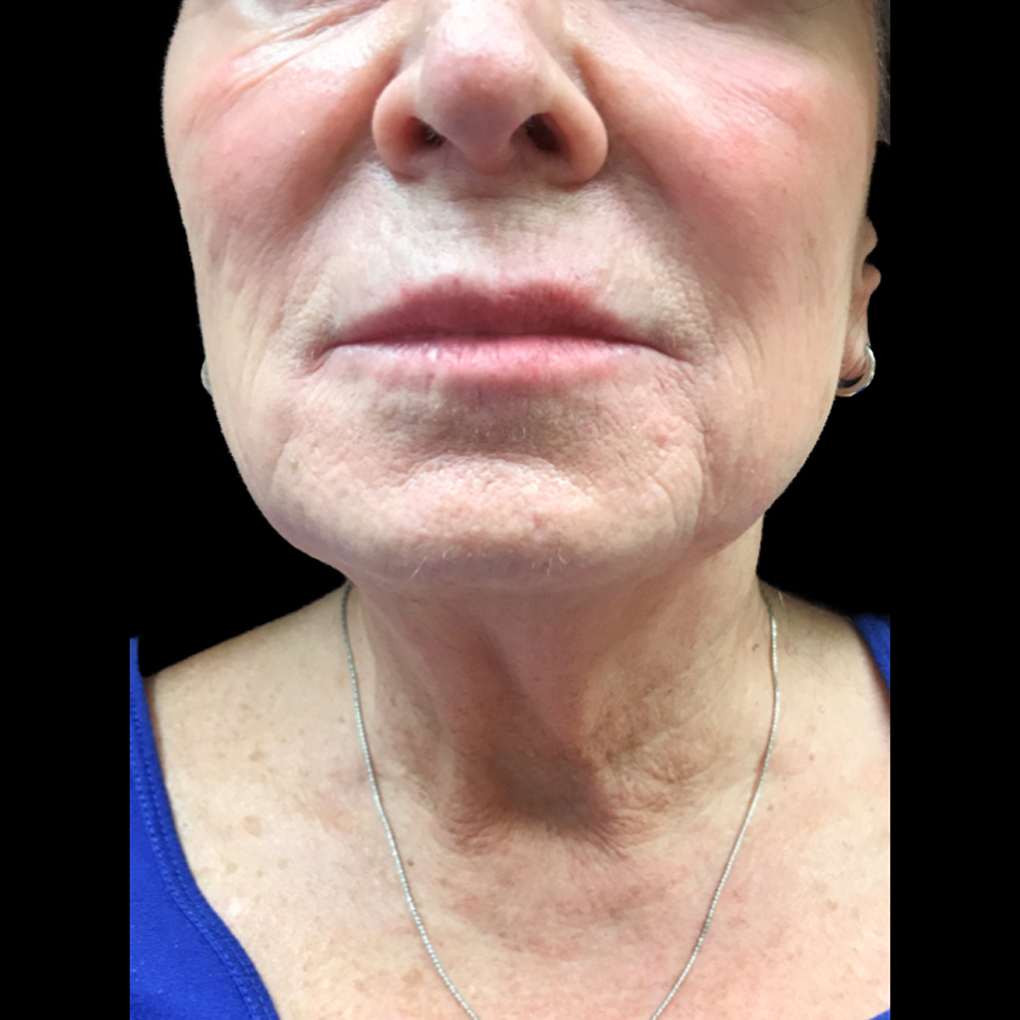 Lip Filler After 1 | Young Medical Spa | Central Valley PA, Lansdale PA, Forty Port PA