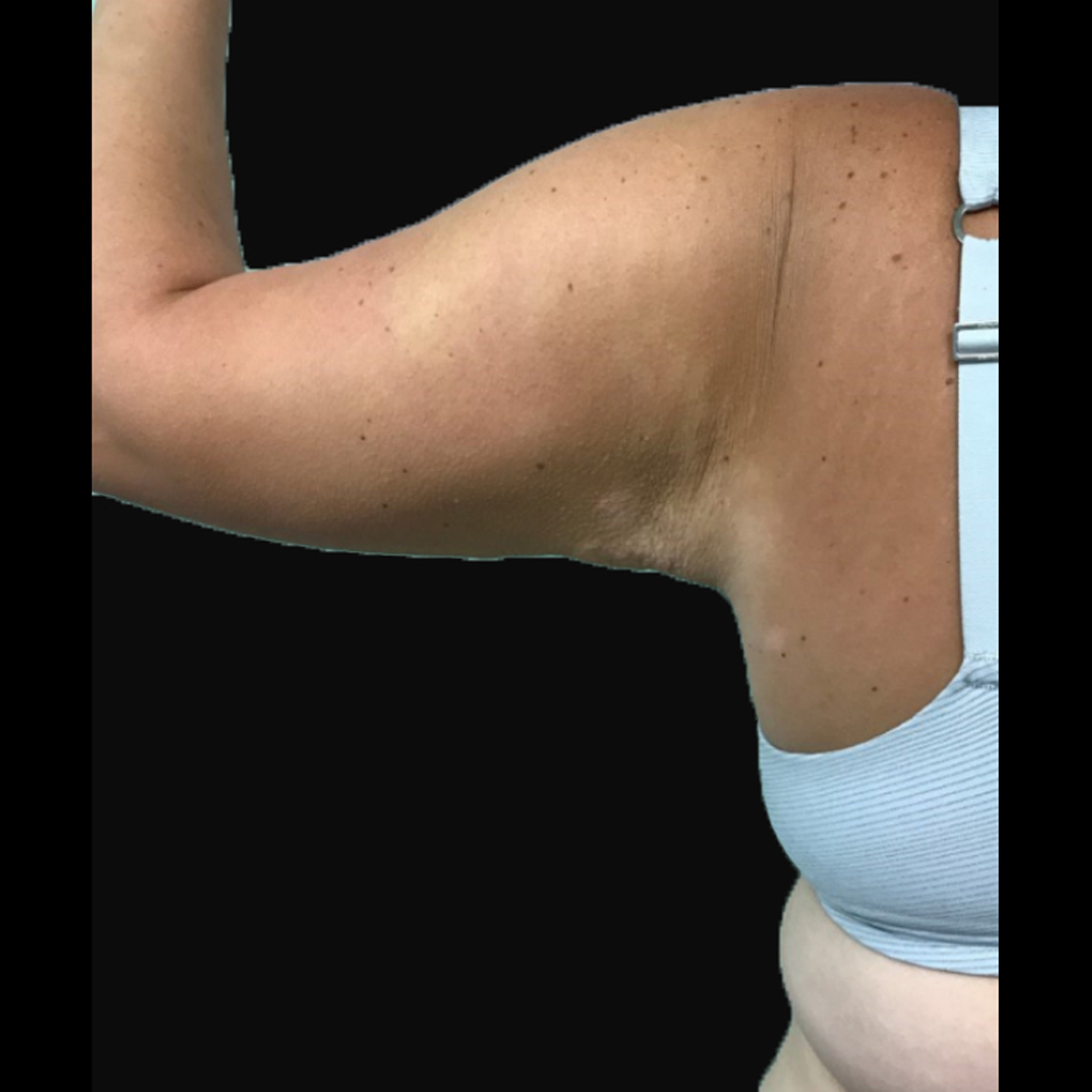 Bodytite Arms After