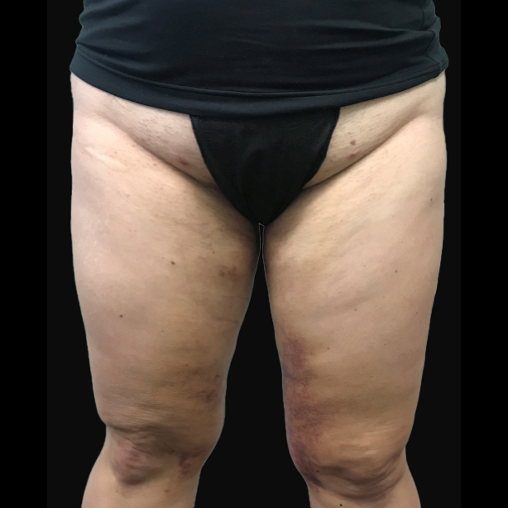 After Smartlipo Inner Thighs and Knee Front View