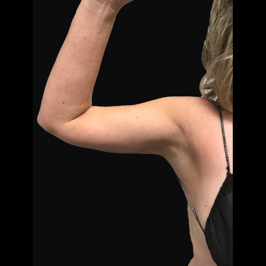 After Smartlipo Right Arm
