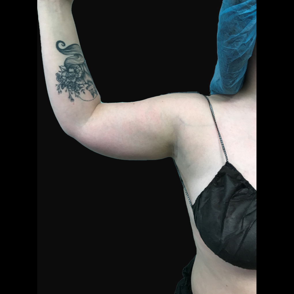 Bodytite Right Arm Before