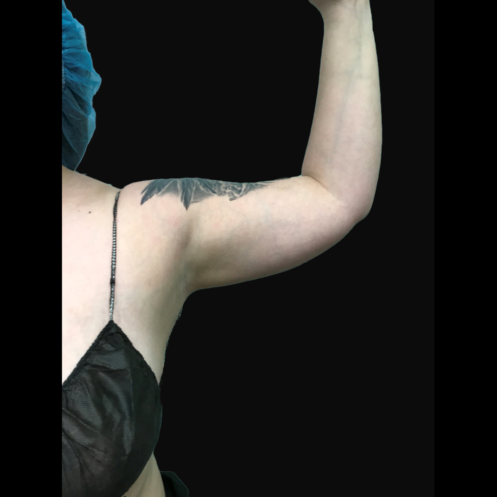 Bodytite Left Arm Before