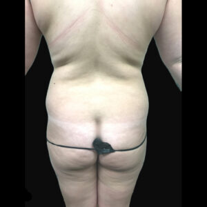 Bodytite Back View Before | Young Medical Spa | Central Valley PA, Lansdale PA, Forty Port PA