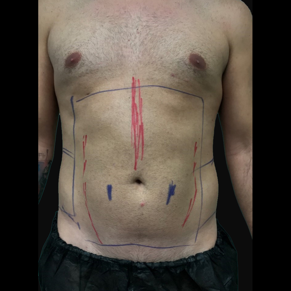 Bodytite Abdomen Before