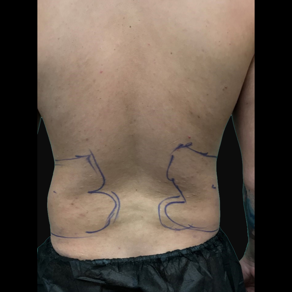Bodytite Waist Before