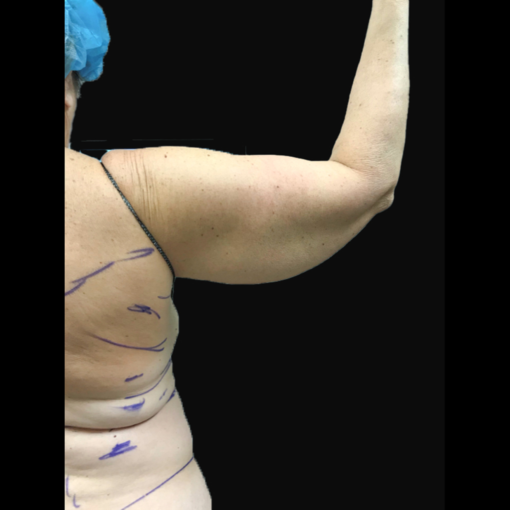 Bodytite Right Arm Before