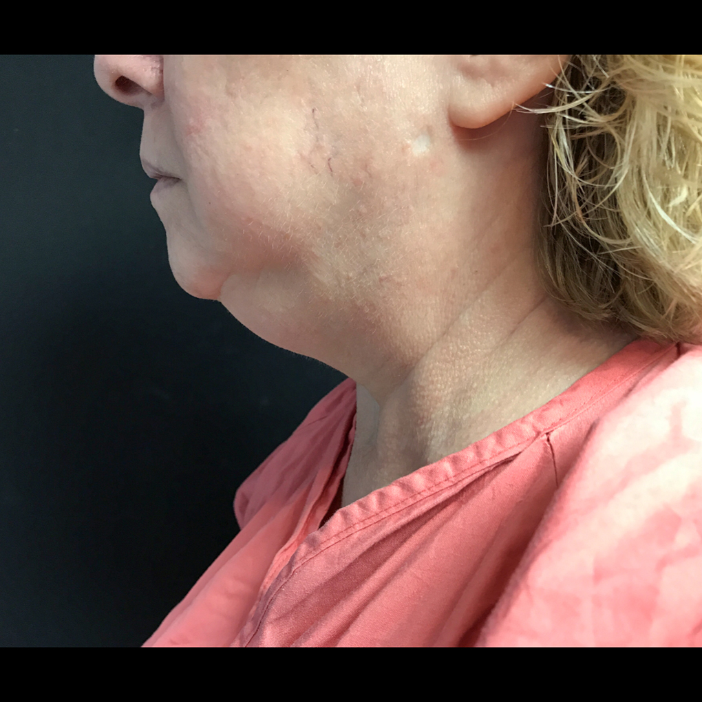 Coolsculpting Chin Side View Before