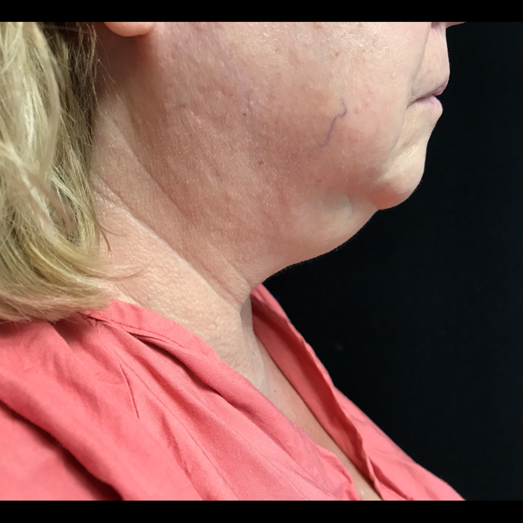 Coolsculpting Chin Side View Before
