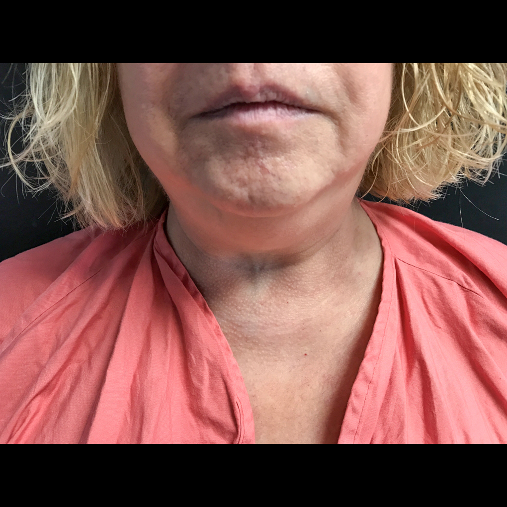 Coolsculpting Chin Front View Before
