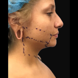 Facetite Chin Right Side Before | Young Medical Spa | Central Valley PA, Lansdale PA, Forty Port PA