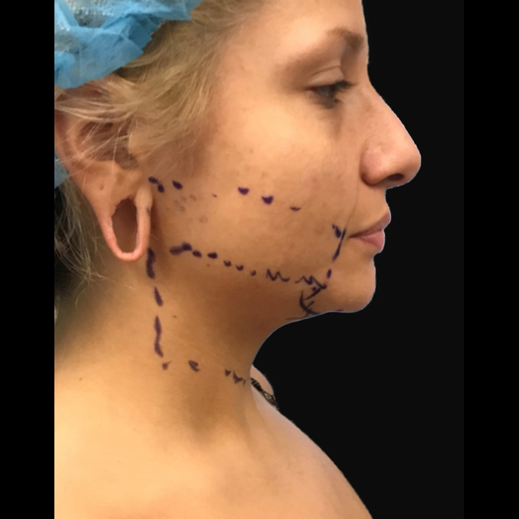 Facetite Chin Right Side Before