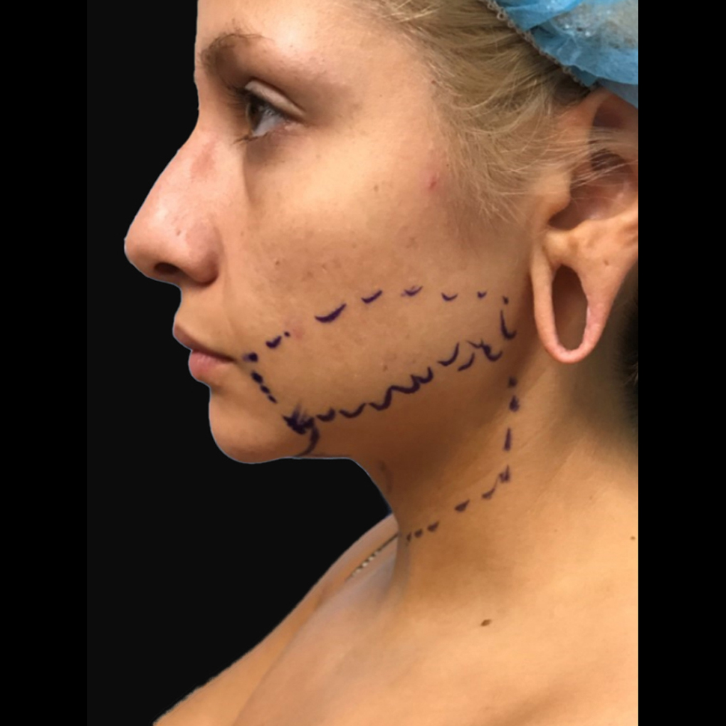Facetite Chin Left Side Before