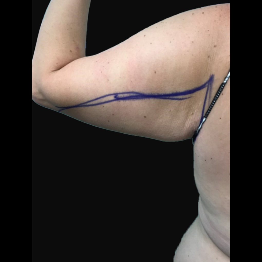 Bodytite Arms Before