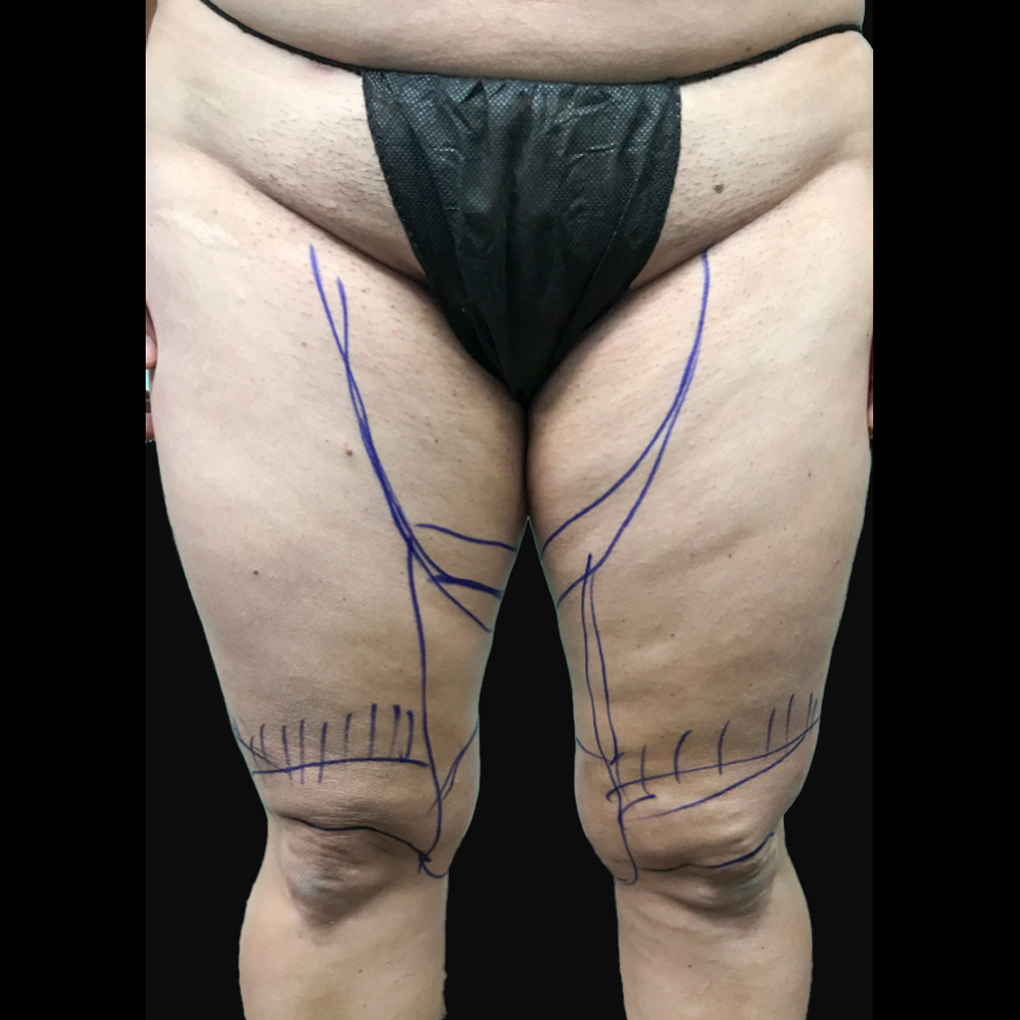 Before Smartlipo Inner Thighs and Knee Front View