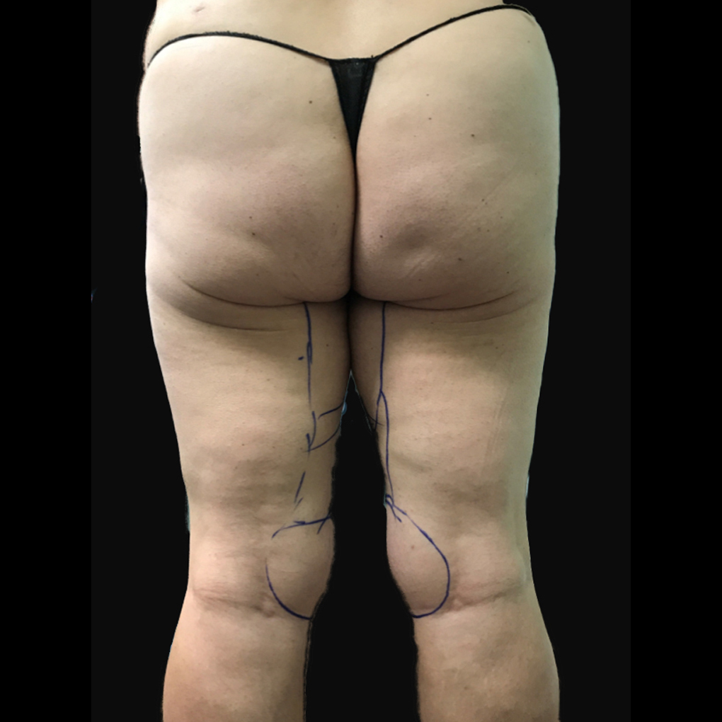 Before Smartlipo Inner Thighs and Knee Back View