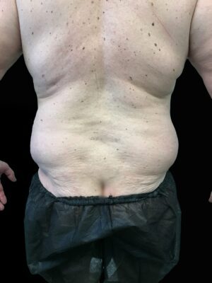 Young Medical Spa BodyTite Before Photo Male | Young Medical Spa | Central Valley PA, Lansdale PA, Forty Port PA
