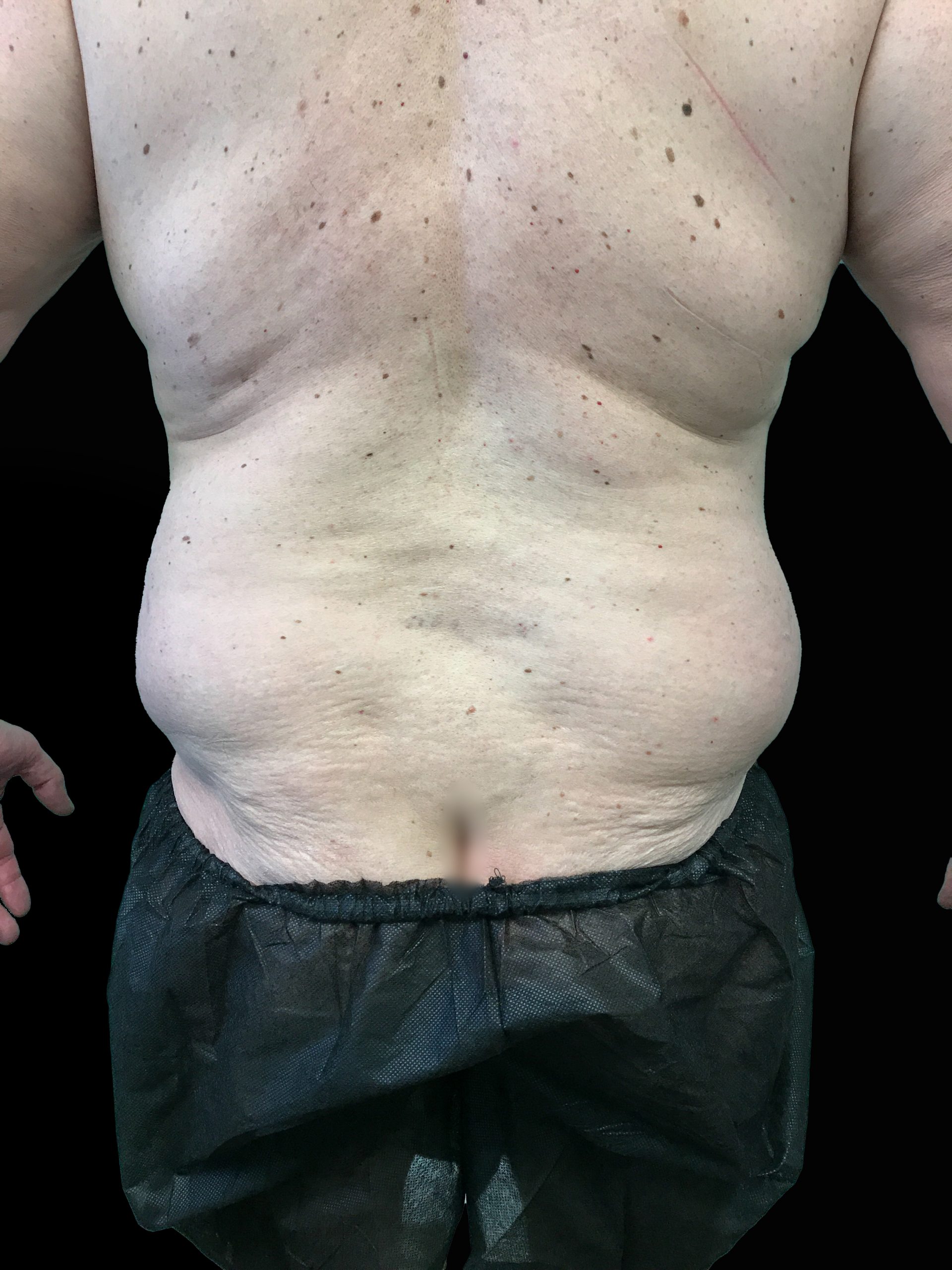Young Medical Spa BodyTite Before Photo Male