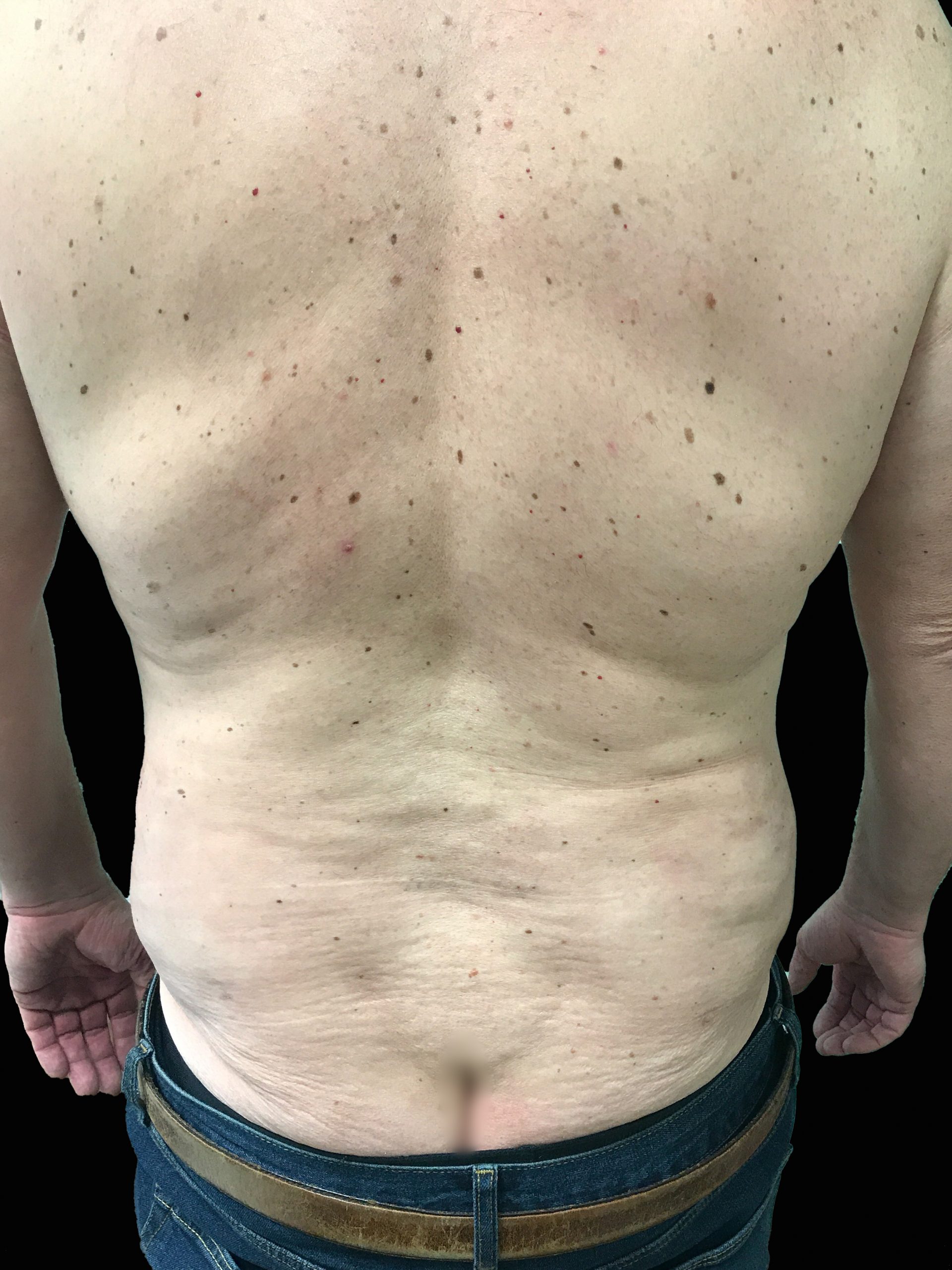 Young Medical Spa BodyTite After Photo Male