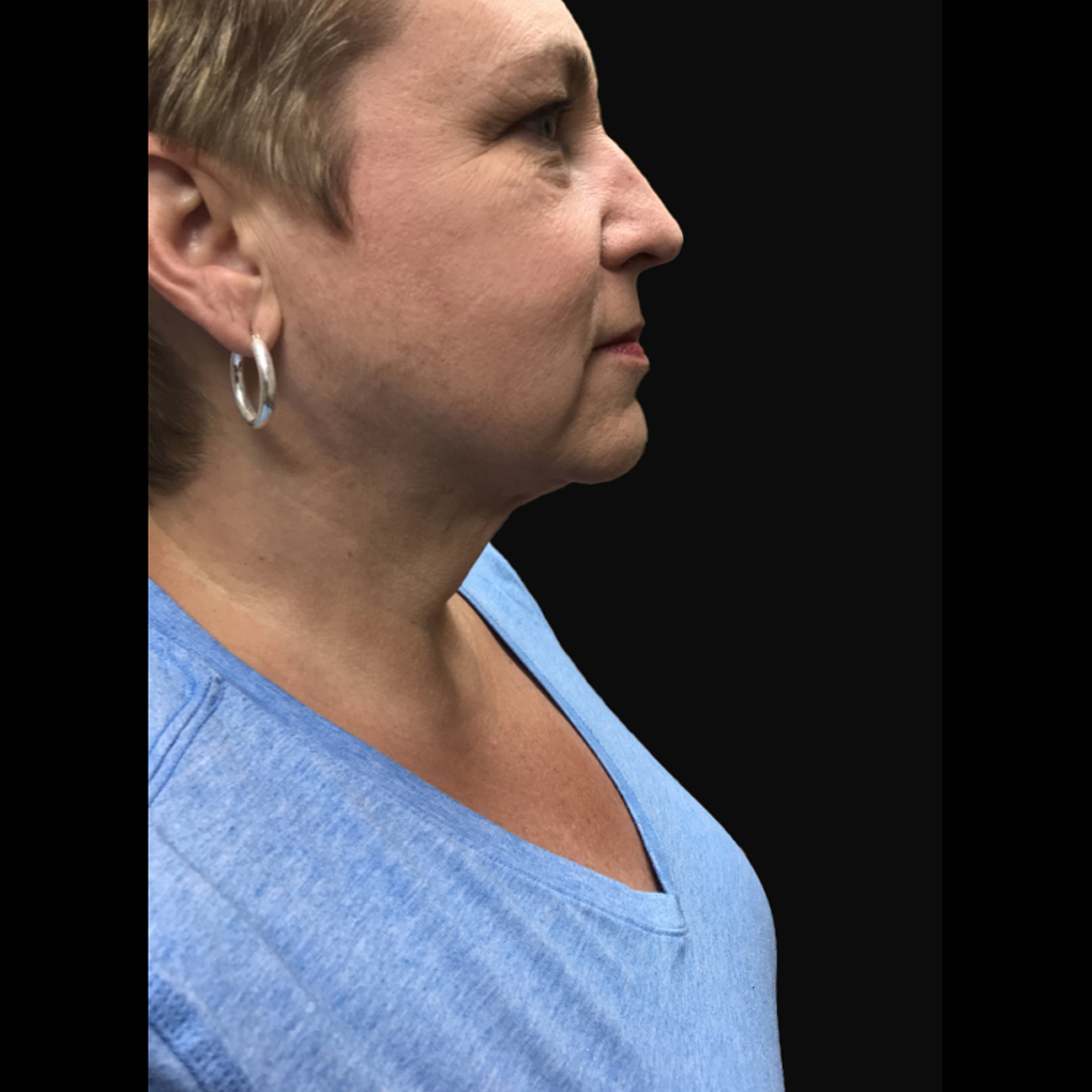 Facetite Right Side After