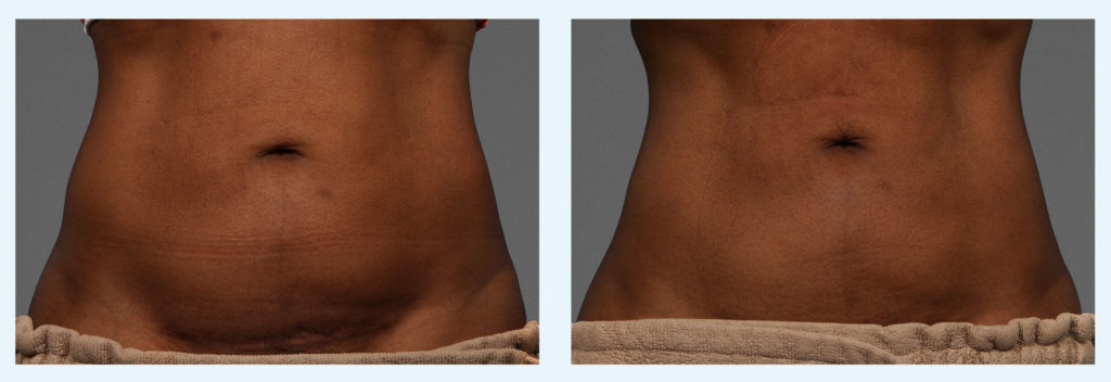 cooltone female treatment before and after | Young Medical Spa | Central Valley PA, Lansdale PA, Forty Port PA